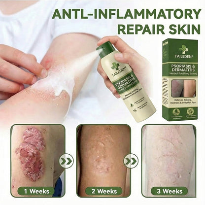 🔥𝗙𝗶𝗻𝗮𝗹 𝟯 𝗛𝗼𝘂𝗿𝘀: 𝟴𝟬% 𝗢𝗙𝗙:𝗧𝗔𝗜𝗟𝗘𝗗𝗘𝗡® 𝗠𝗮𝗴𝗻𝗲𝘀𝗶𝘂𝗺 𝗛𝗲𝗿𝗯𝗮𝗹 𝗣𝘀𝗼𝗿𝗶𝗮𝘀𝗶𝘀 𝗦𝗽𝗿𝗮𝘆